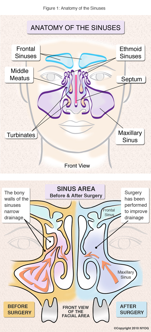 sinuses of head diagram. The maxillary sinuses are the