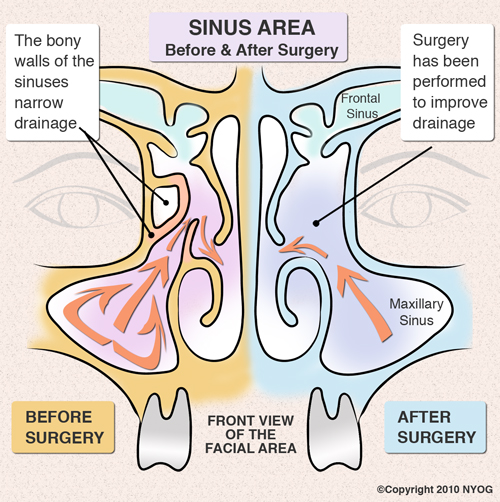 Sinus area before and after surgery diagram