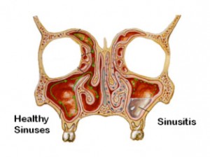 healthy-sinusitis illustration Heathy & Sinusitis diagram