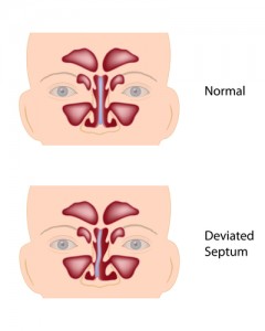 deviated septum and sinusitus